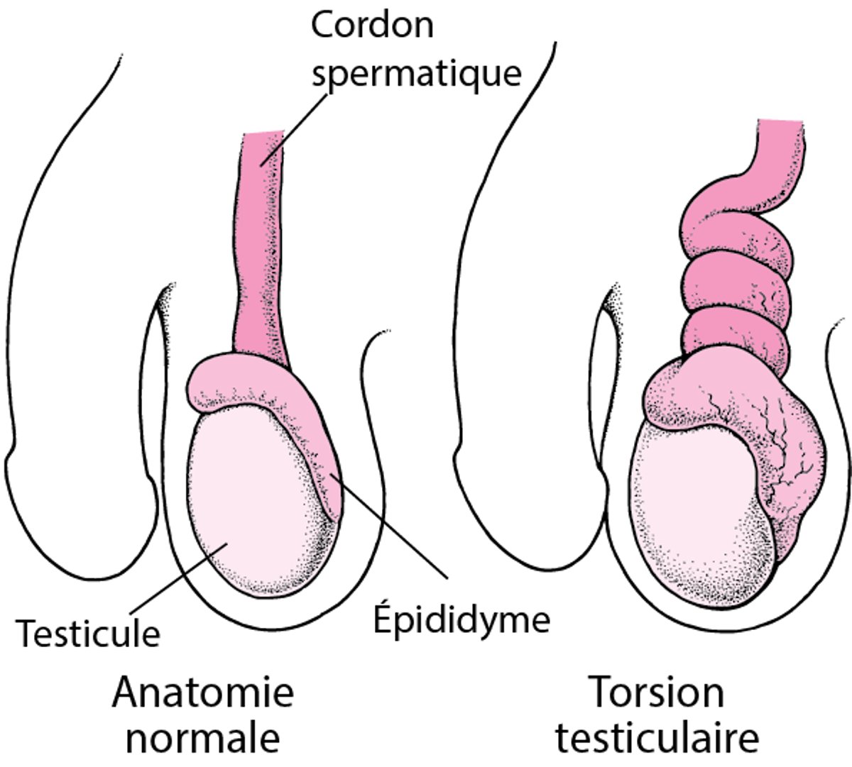 Qu’est-ce qu’une torsion testiculaire ?
