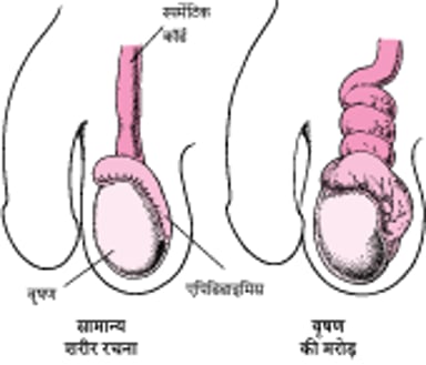 वृषण मरोड़ क्या है?