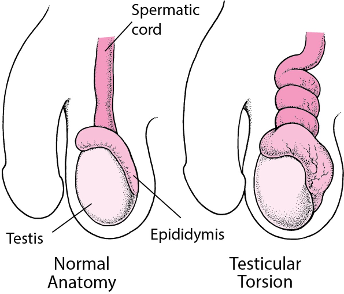 Apa itu Torsio Testis?