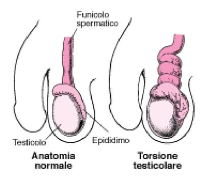 Che cos’è la torsione testicolare?