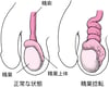 精巣せいそう捻転ねんてんとは