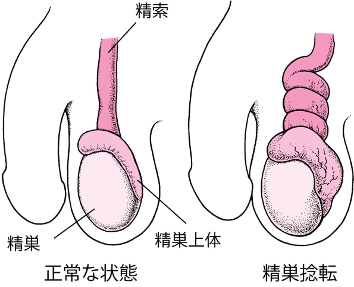 精巣せいそう捻転ねんてんとは