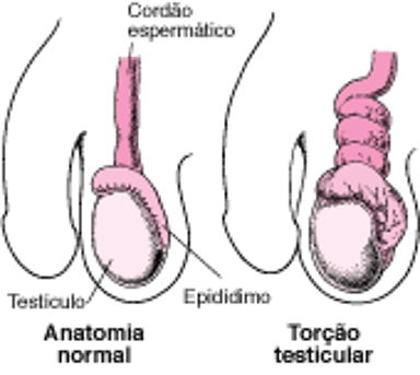 O que é torção testicular?