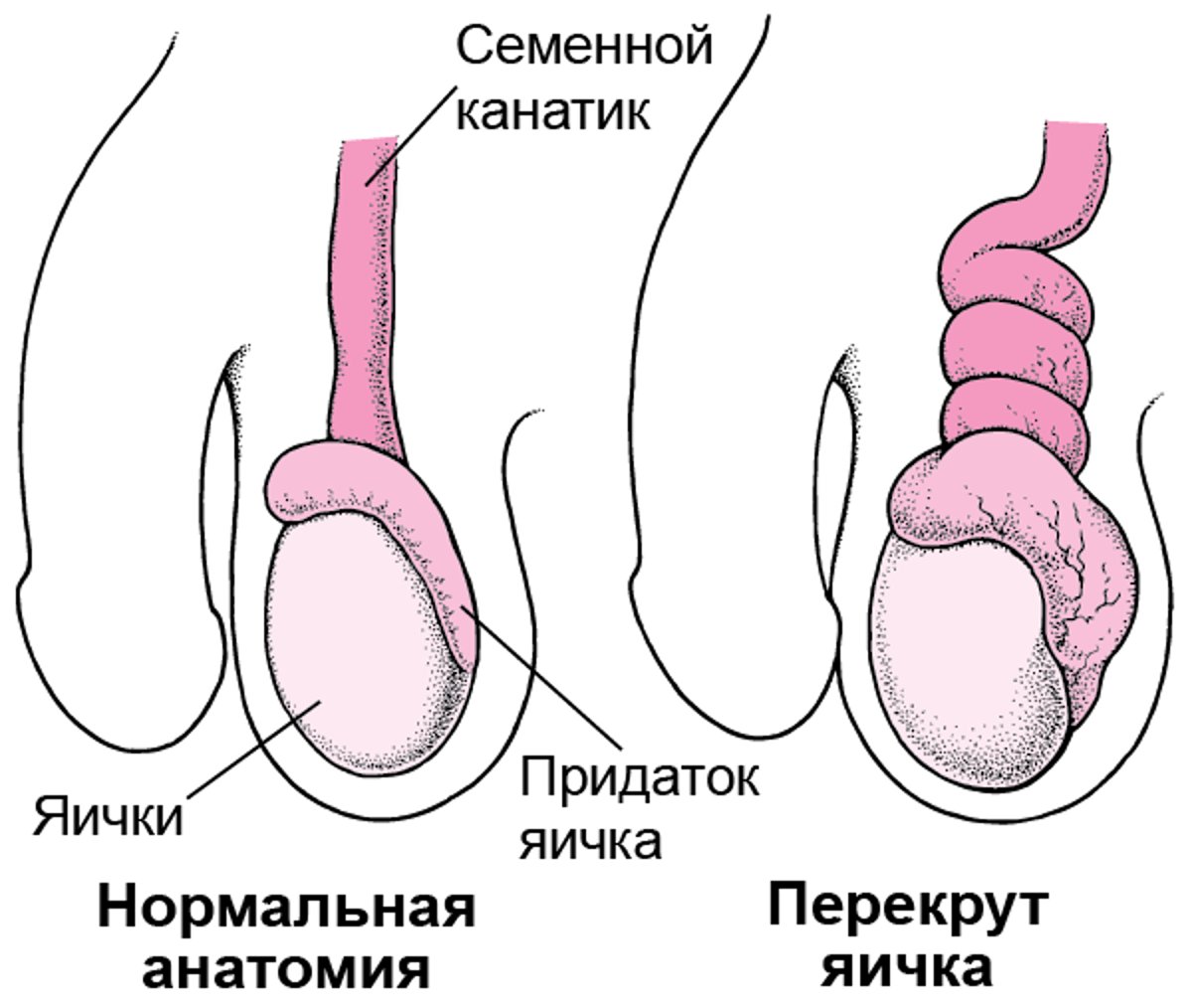 Что такое перекрут яичка?