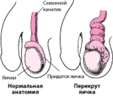 Что такое перекрут яичка?