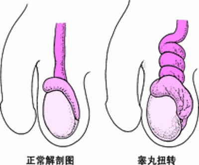 什么是睾丸扭转？