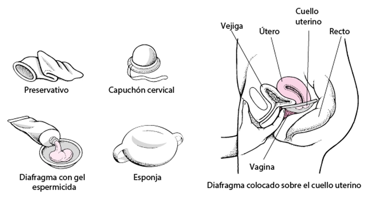Bloqueo de la entrada de los espermatozoides: anticonceptivos de barrera