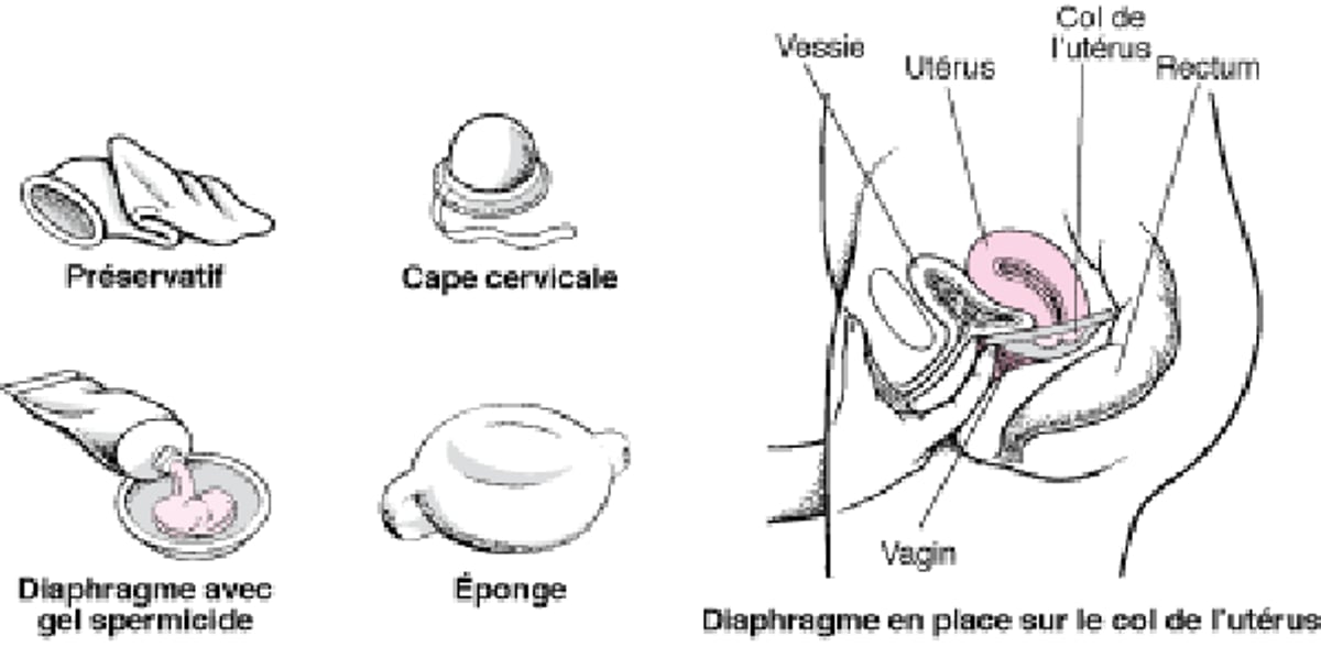 Bloquer l’accès : Barrières contraceptives