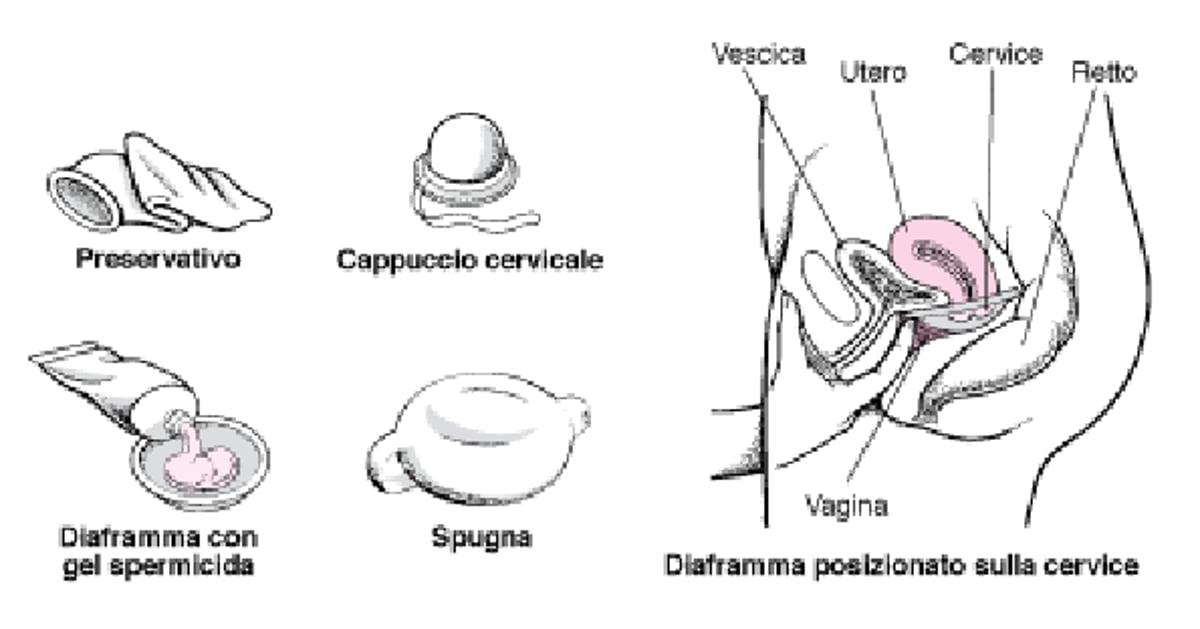 Blocco dell’accesso: Contraccettivi di barriera