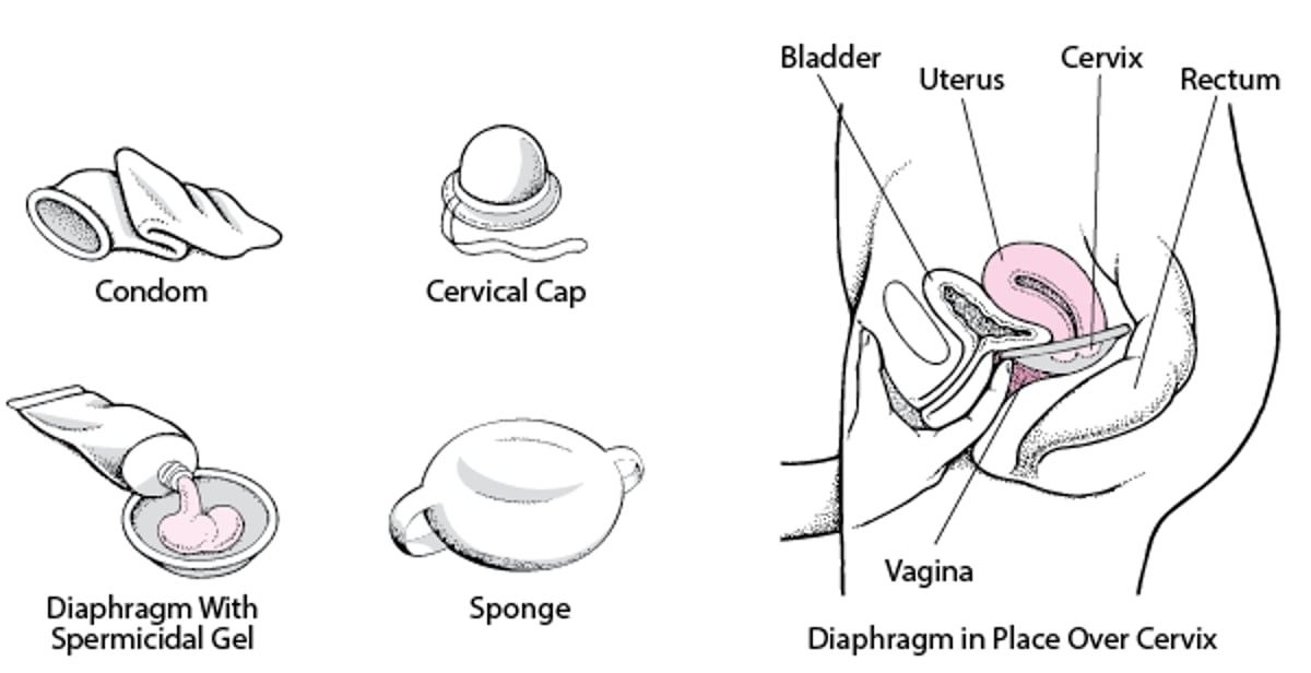 접근 차단: 장벽 피임법