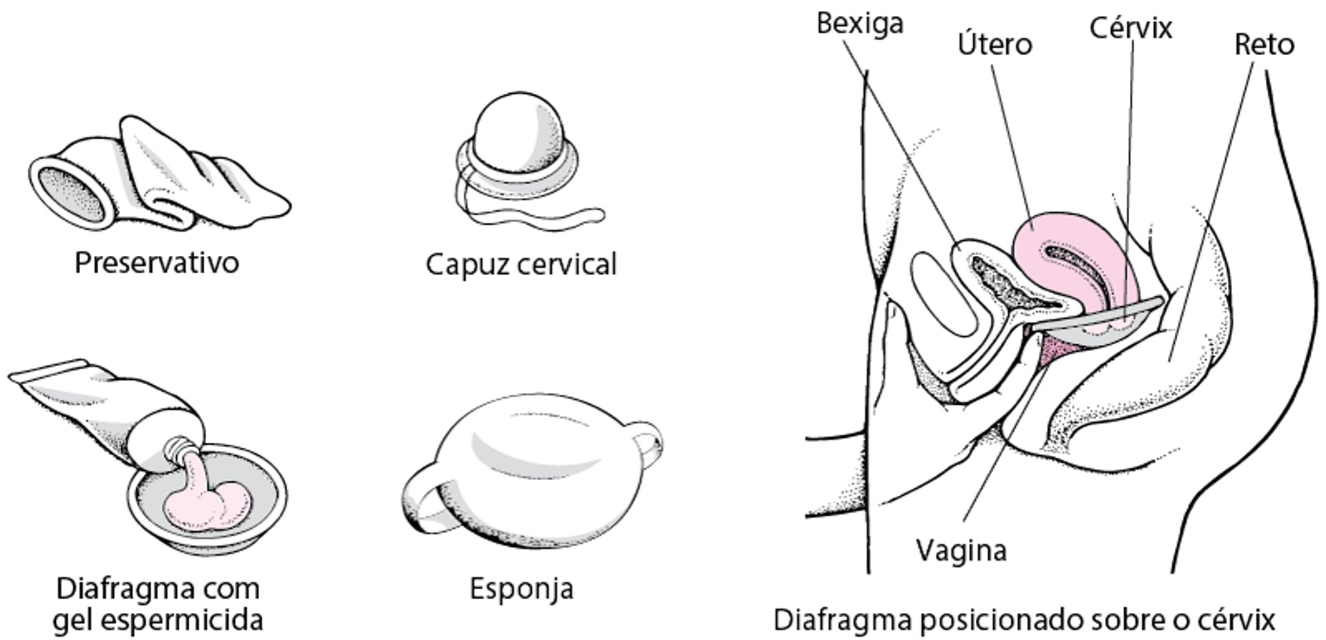 Bloqueio do acesso: Contraceptivos de barreira