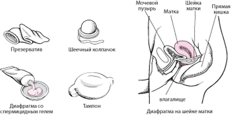 Блокирование доступа: Барьерные контрацептивные средства
