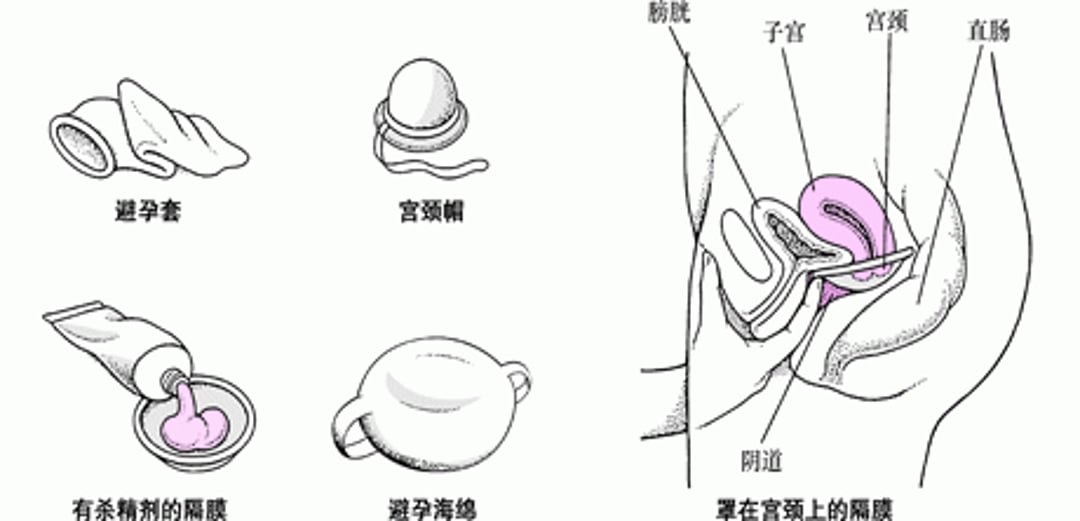 防止到达：工具避孕