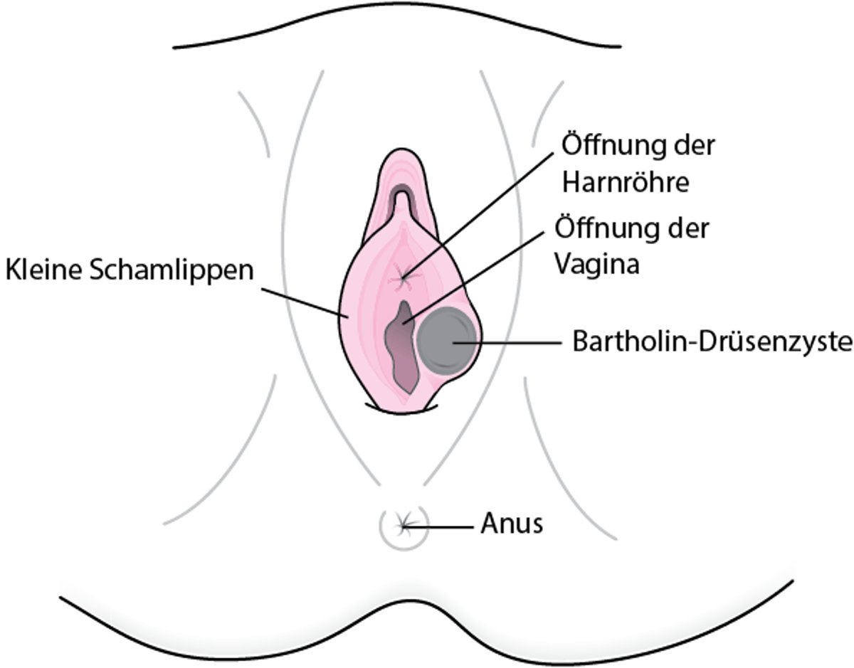 Was ist eine Bartholin-Zyste?