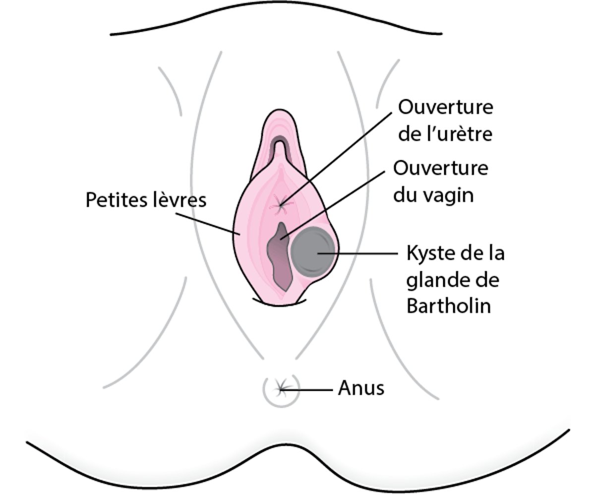 Qu’est-ce qu’un kyste des glandes de Bartholin ?