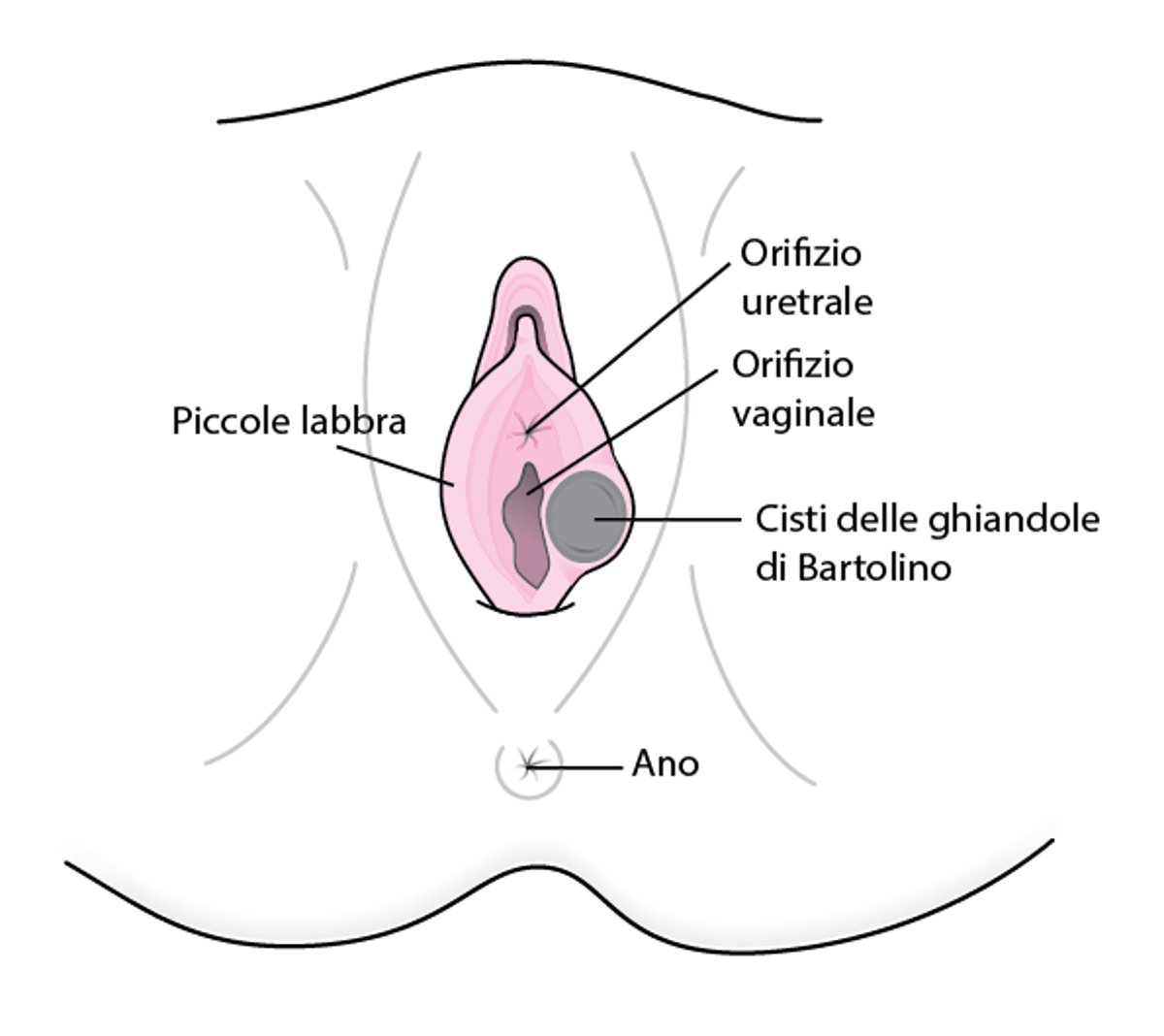 Che cos’è la cisti delle ghiandole di Bartolino?