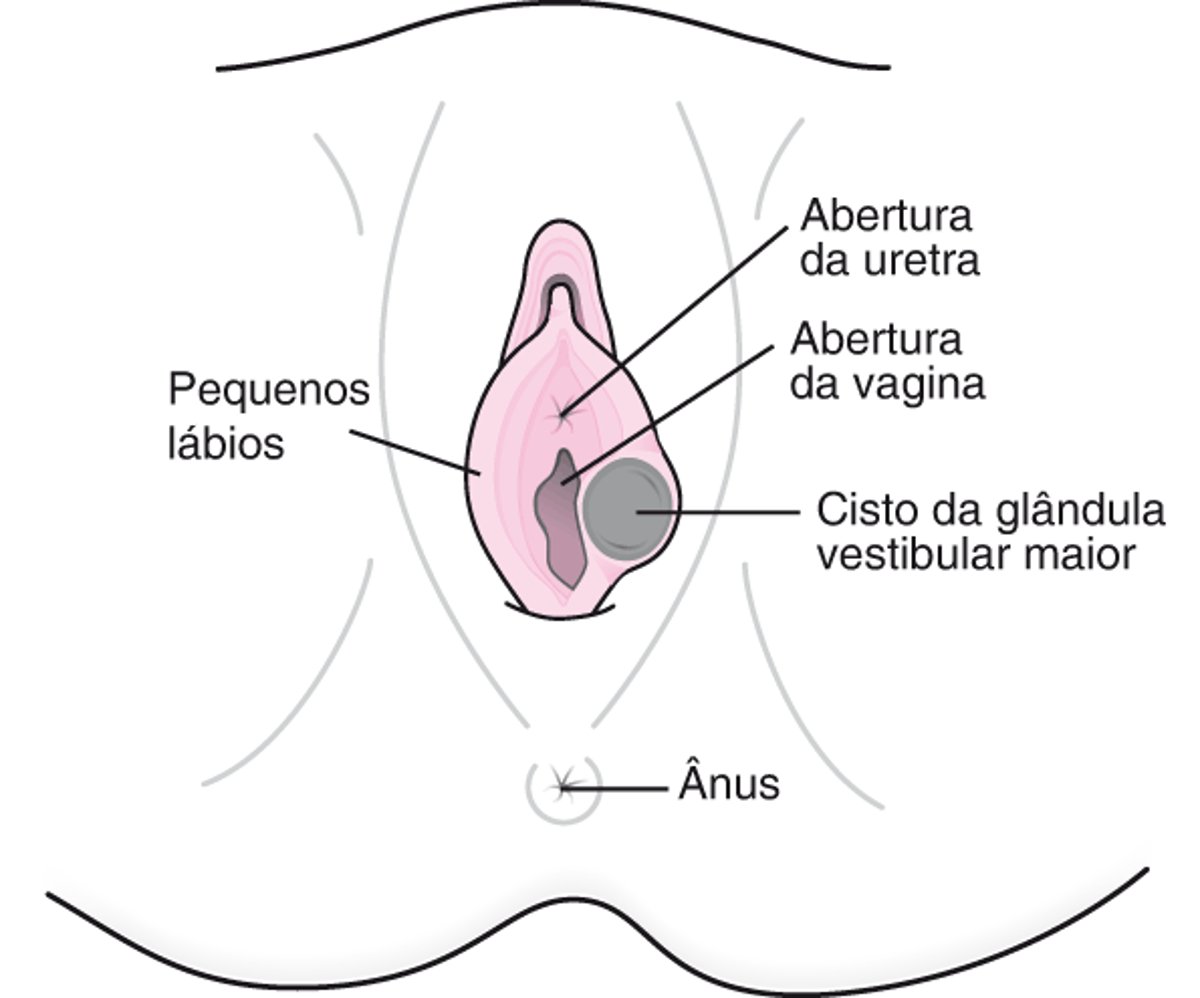 O que é um cisto da glândula de Bartholin?