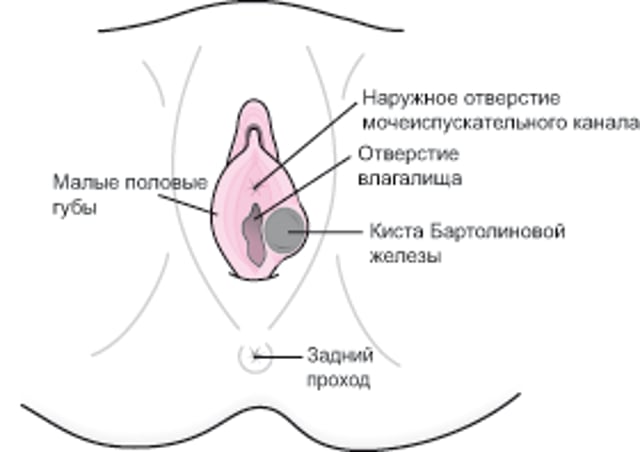 Что такое киста бартолиновой железы?