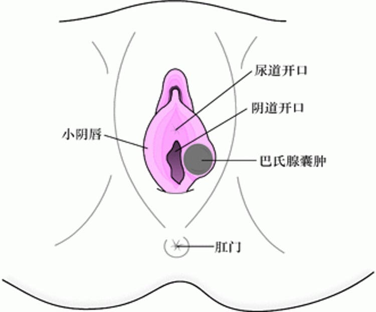 什么是巴氏腺囊肿？