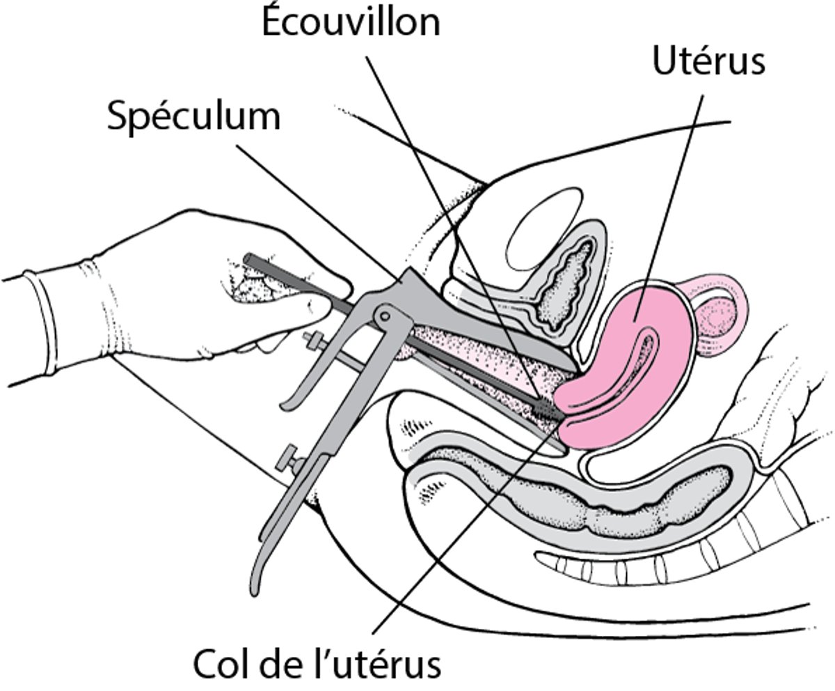 Prélèvement de cellules du col de l’utérus