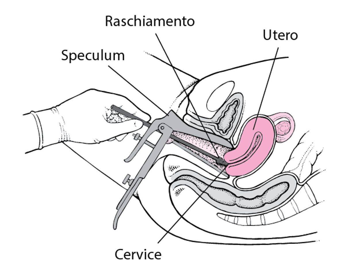 Prelievo di cellule cervicali