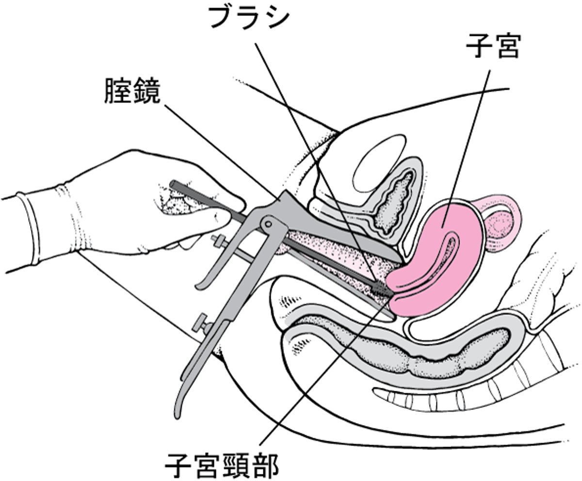 子宮頸部の細胞の採取