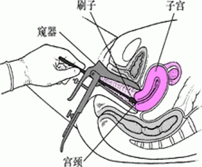 宫颈抹片检查