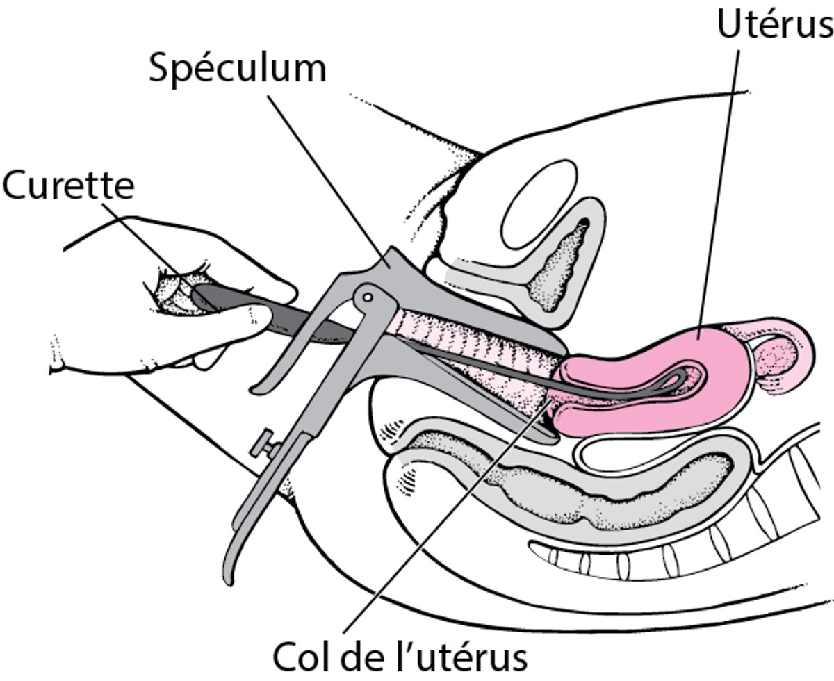 Dilatation et curetage