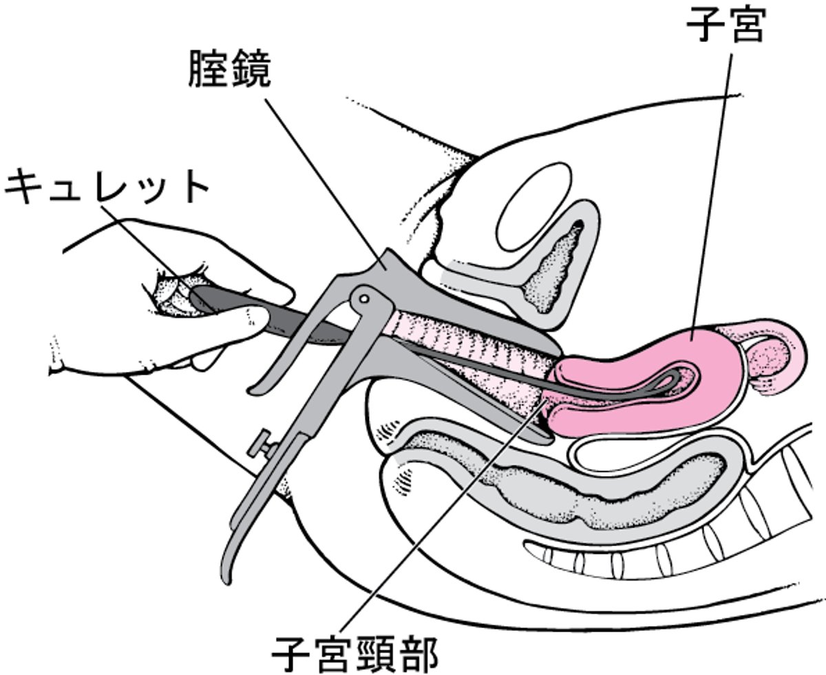 頸管拡張・内膜掻爬