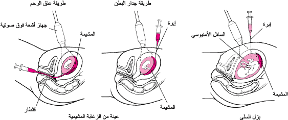 اكتشاف الشذوذات قبل الولادة