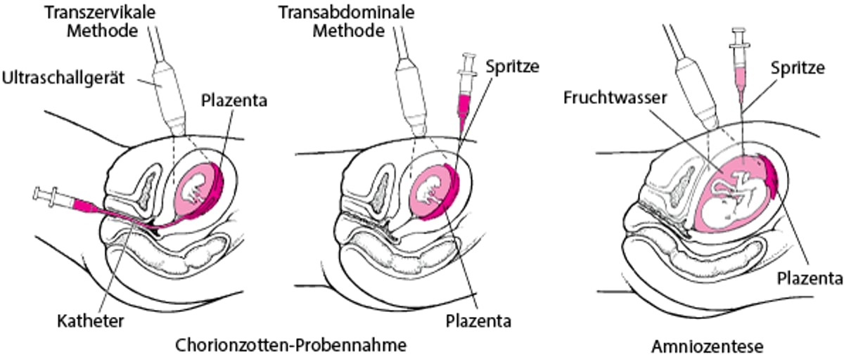 Ermittlung von Fehlbildungen vor der Geburt