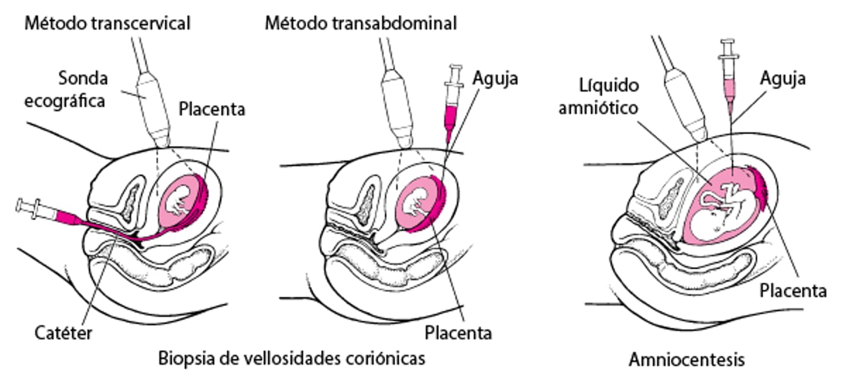 Detección de anomalías antes del nacimiento
