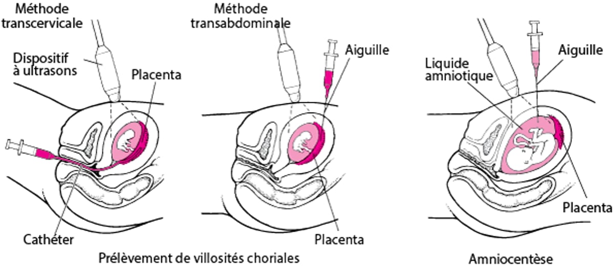 La détection des anomalies avant la naissance