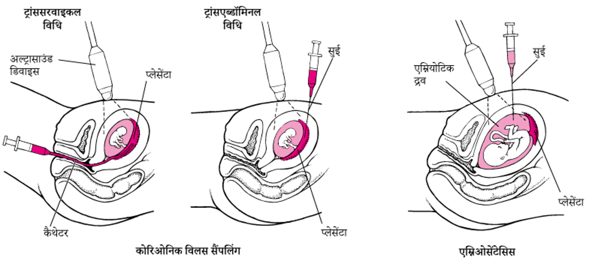जन्म से पहले असामान्यताओं का पता लगाना