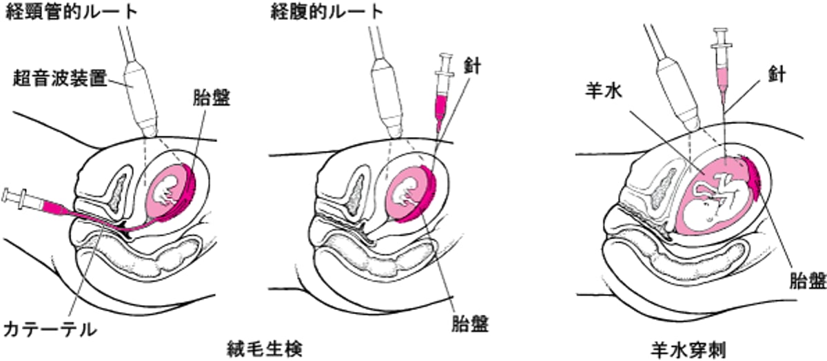 出生前に異常を発見する