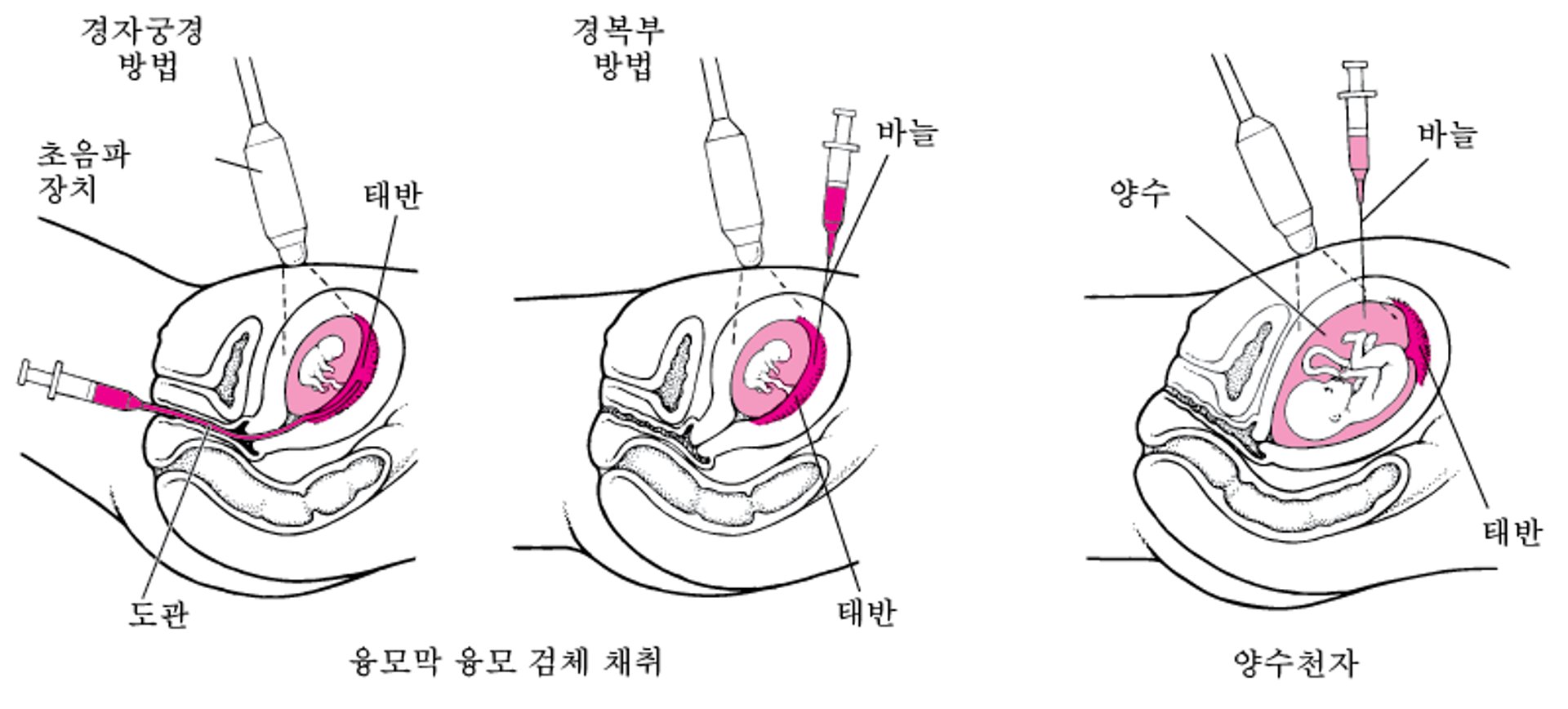 출산 전 이상 감지