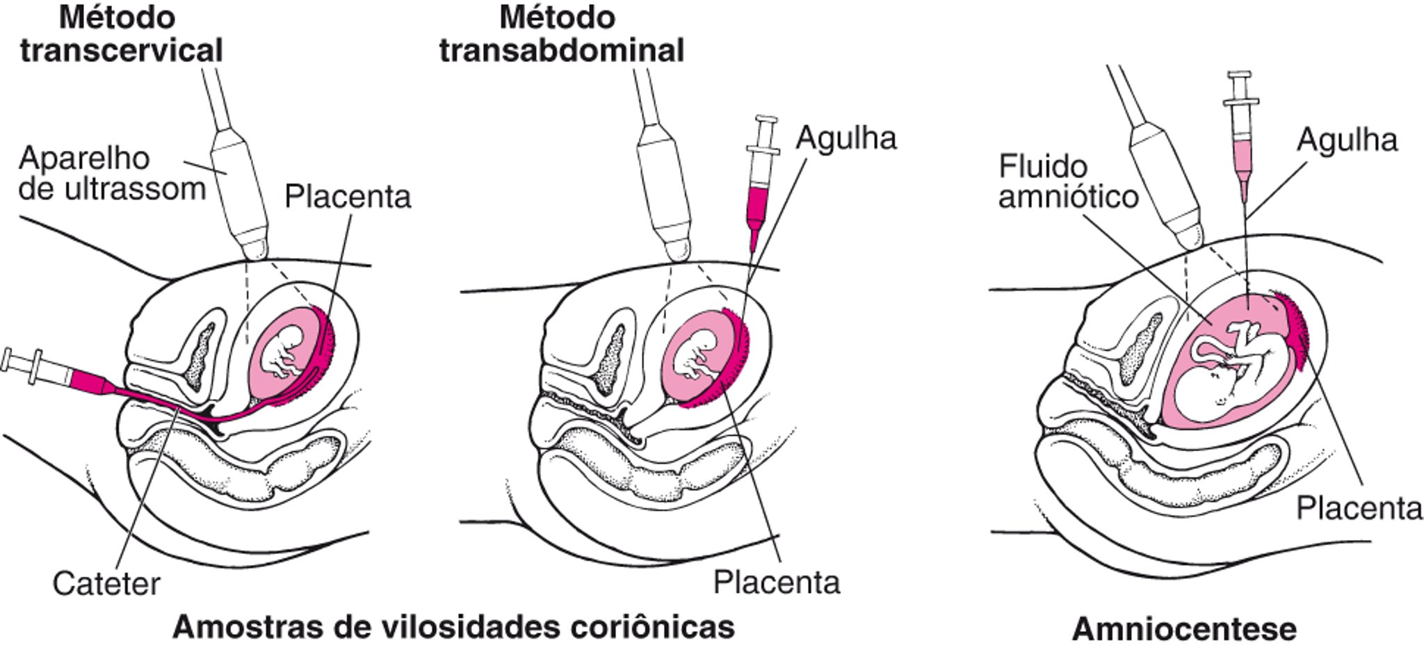 Detecção de anomalias antes do nascimento