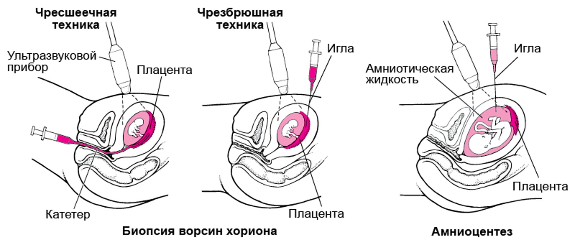 Обнаружение отклонений до рождения ребенка