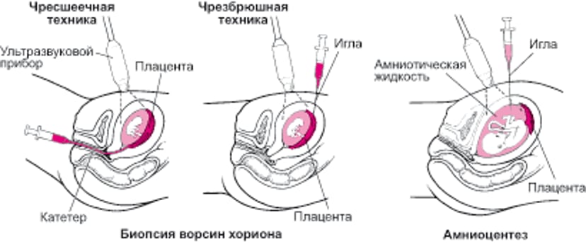 Обнаружение отклонений до рождения ребенка