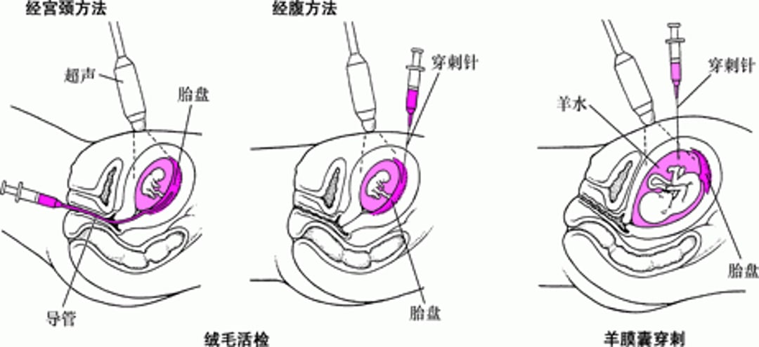 产前胎儿异常检测