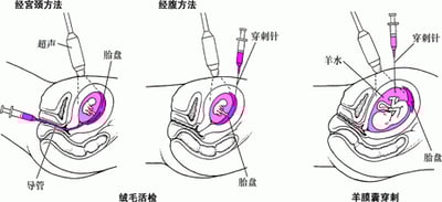 产前胎儿异常检测