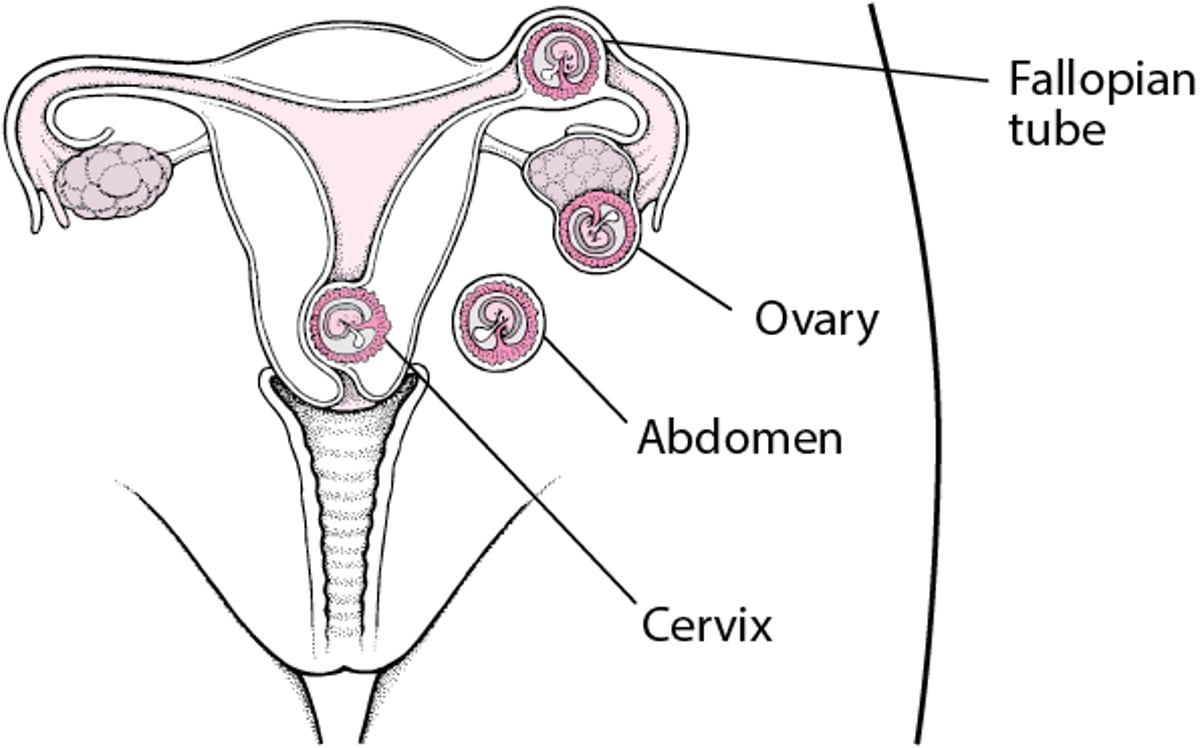 Ectopic Pregnancy: A Mislocated Pregnancy