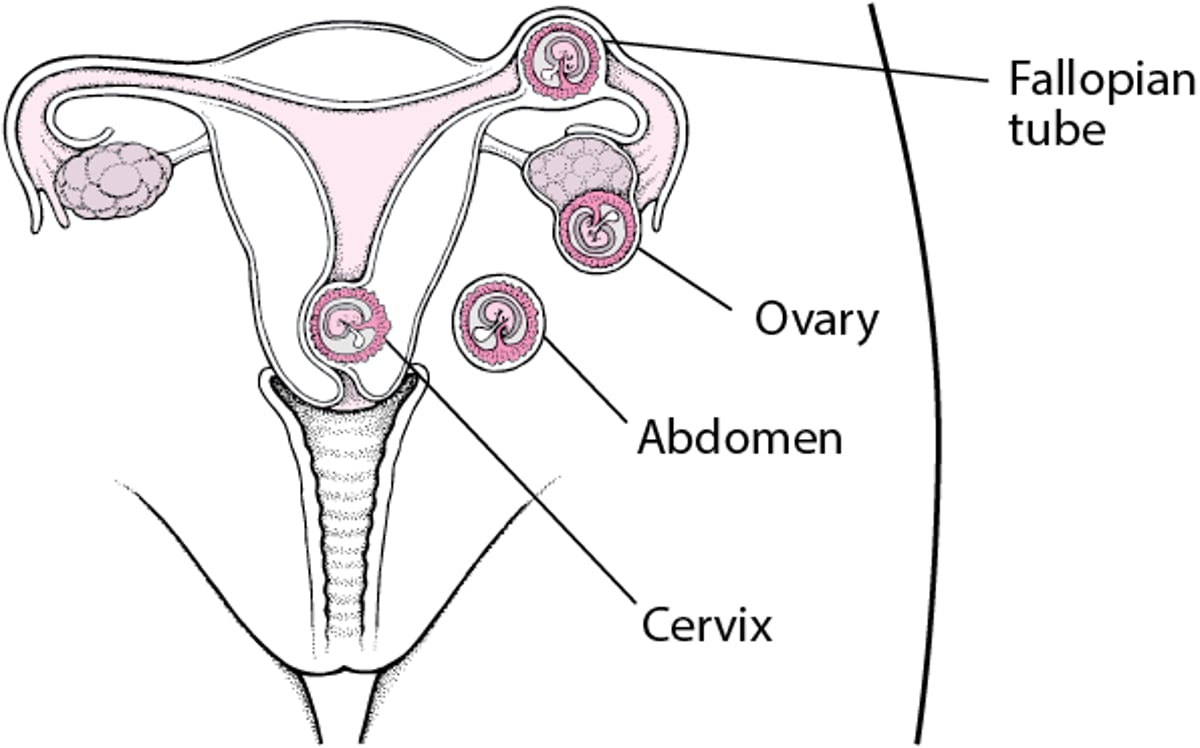 ektope Schwangerschaft: Eine Schwangerschaft außerhalb der Gebärmutter