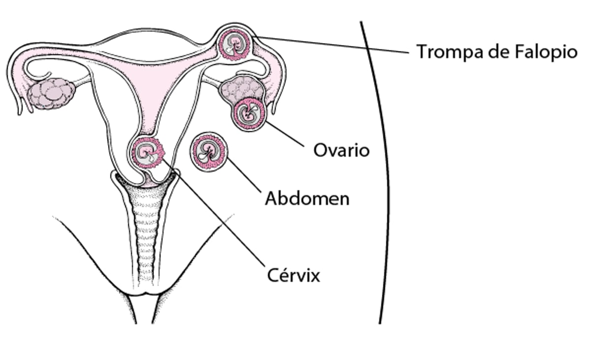 Embarazo ectópico: un embarazo extrauterino