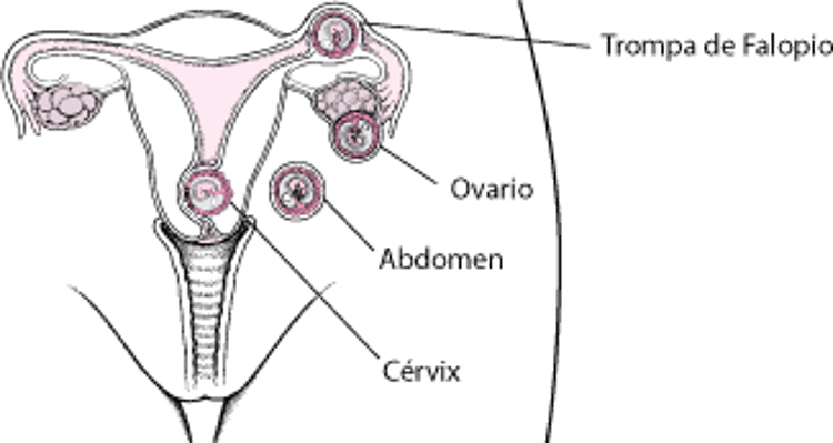 Embarazo ectópico: un embarazo extrauterino