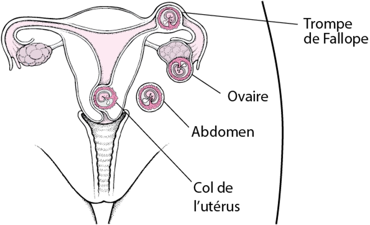 Grossesse extra-utérine : une grossesse au mauvais endroit