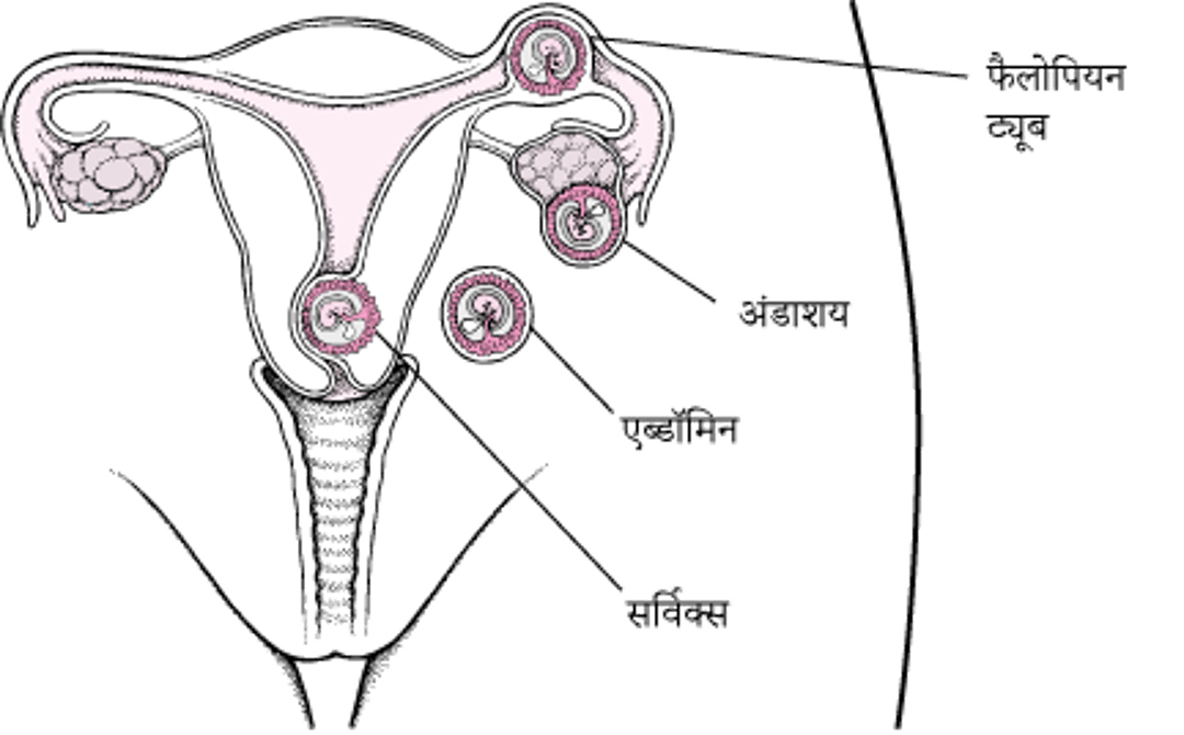 अस्थानिक गर्भावस्था: गलत स्थान पर स्थित गर्भावस्था
