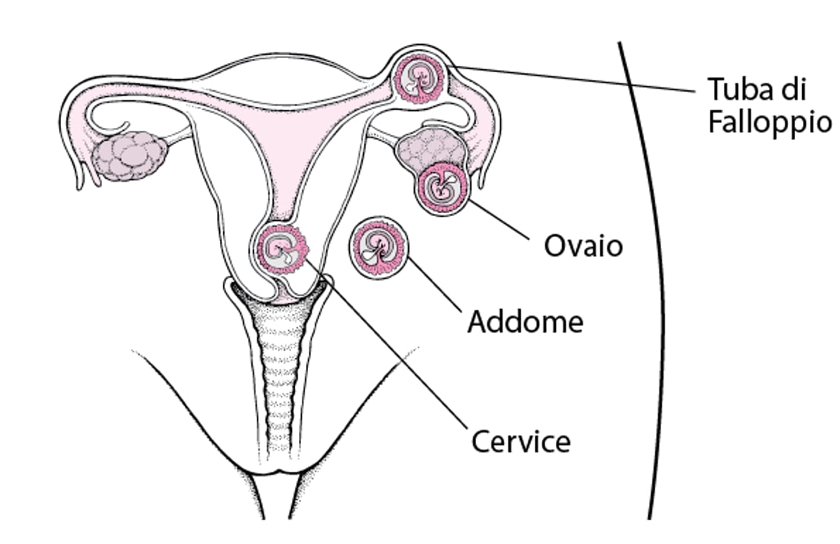 Gravidanza ectopica: una gravidanza in sede anomala