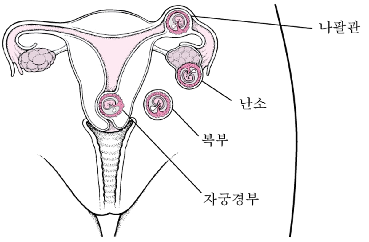자궁외 임신: 잘못된 임신