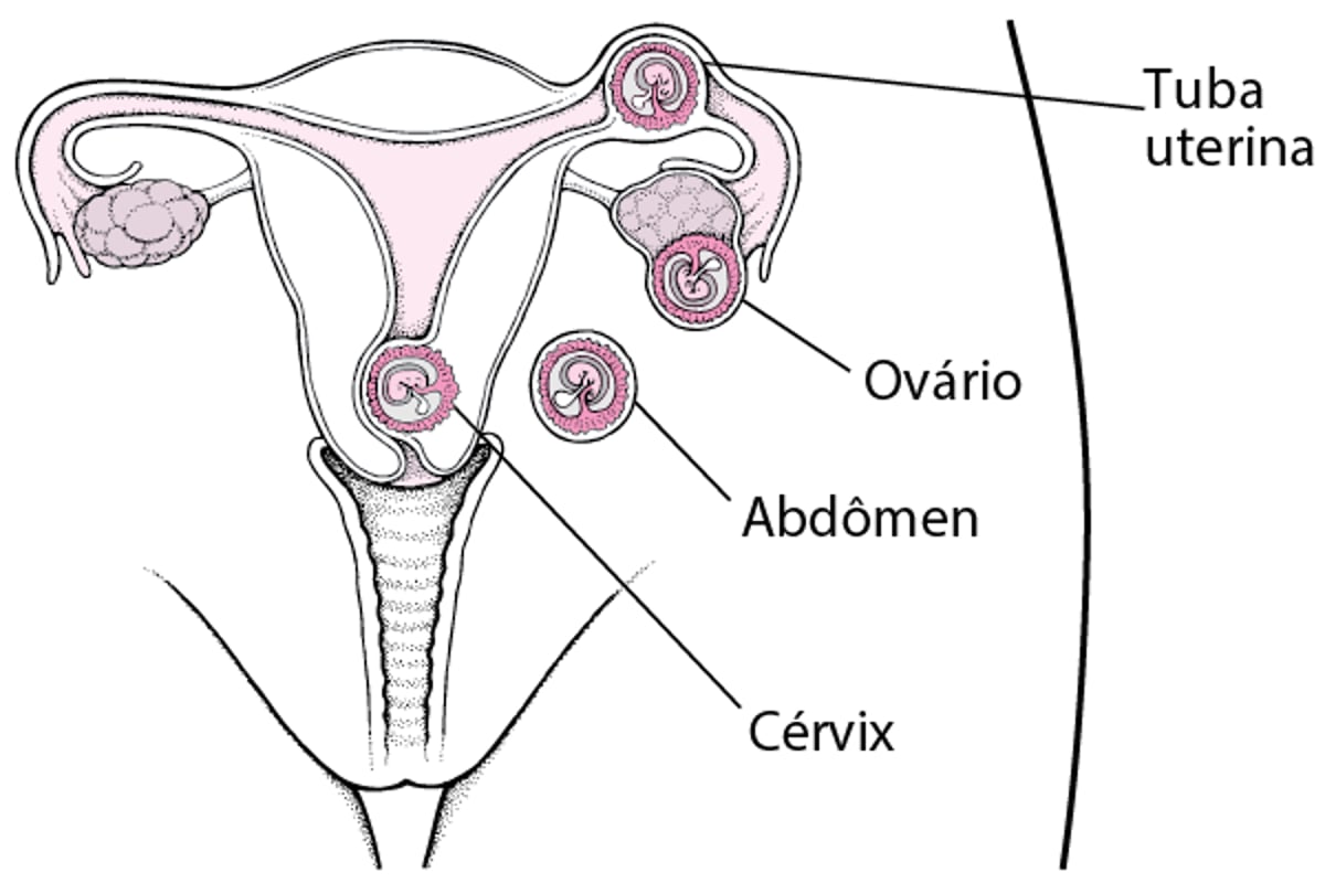Gravidez ectópica: Uma gravidez fora do útero